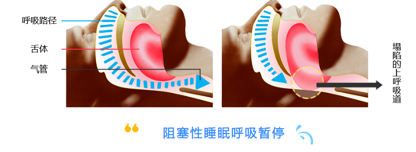 无创呼吸机,高流量呼吸湿化治疗仪,睡眠监测	