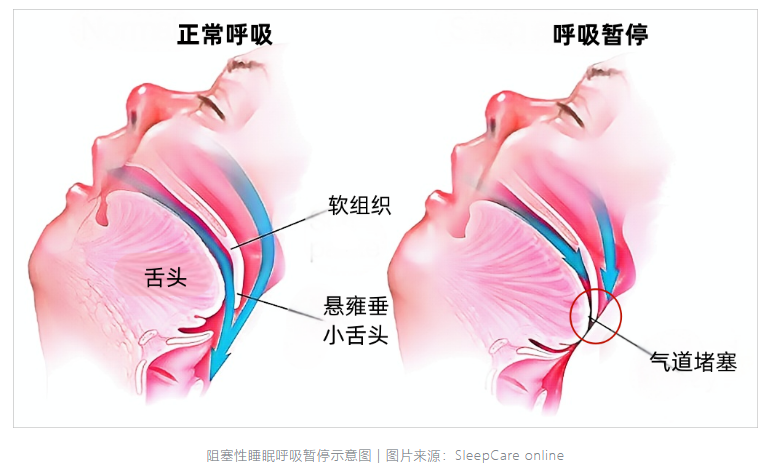 无创呼吸机,高流量呼吸湿化治疗仪,睡眠监测